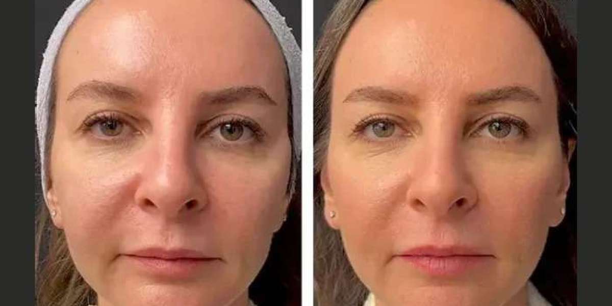 Best Doctors in Dubai for Customized Mesotherapy Plans