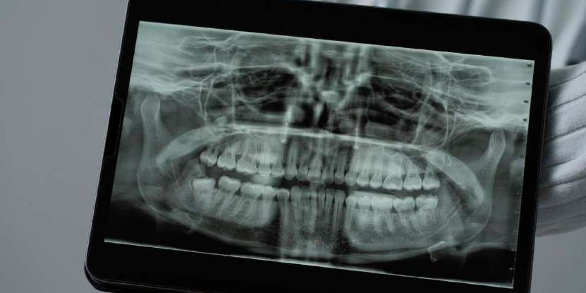 The Role of Radiology in Detecting Impacted Wisdom Teeth