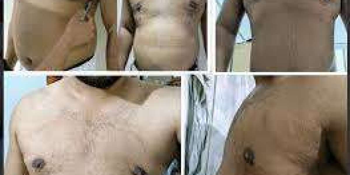 Gynecomastia Surgery Cost in Pakistan: What Every Patient Should Know